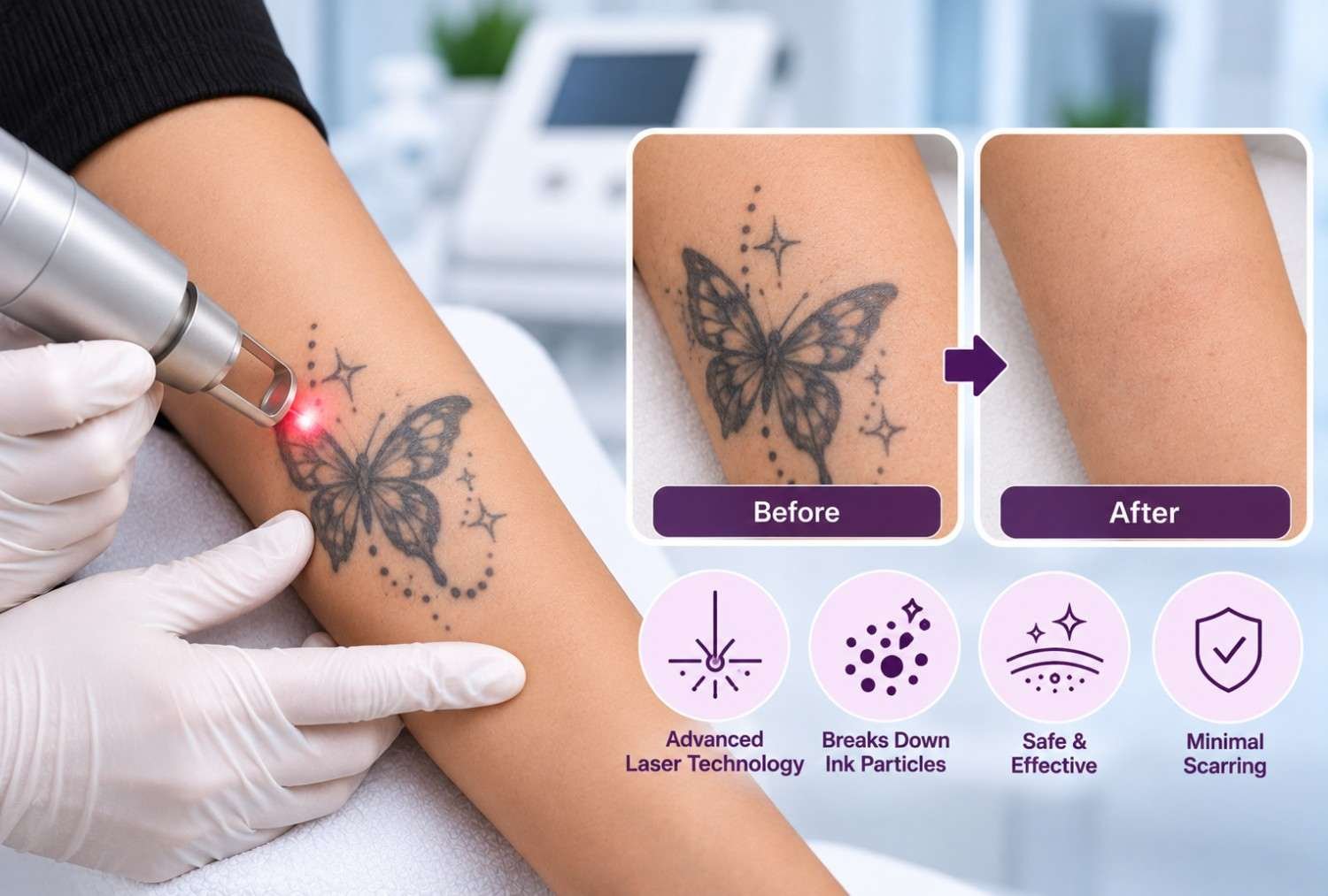 Tattoo Removal Laser Treatment