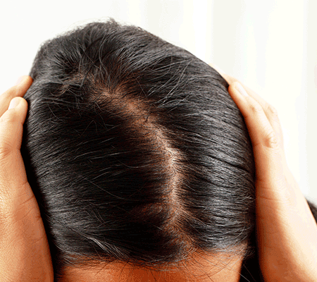 Excessive Hair Loss